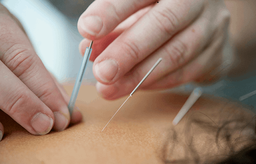Foto de un terapeuta de acupuntura aplicando la terapia en un paciente